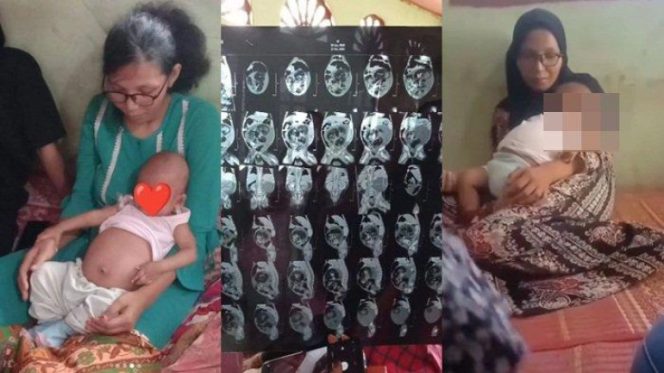
					Bayi Diduga Hamil Ternyata Alami Tumor Teratoma Sebesar Dua Kilo