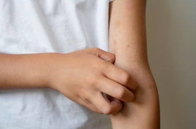 
					Berikut yang Sebabkan Penyakit Cacar Sulit Diberantas
