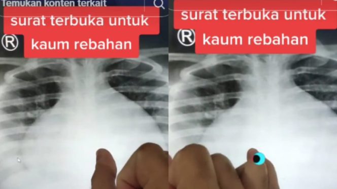 
					Seorang Dokter Ungkap Kebiasaan Rebahan Bisa Akibatkan Pembengkakan Jantung